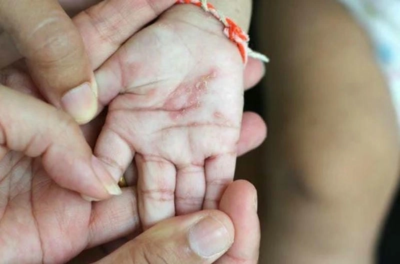 Hình ảnh bị ghẻ nước minh họa chi tiết từng nốt mụn