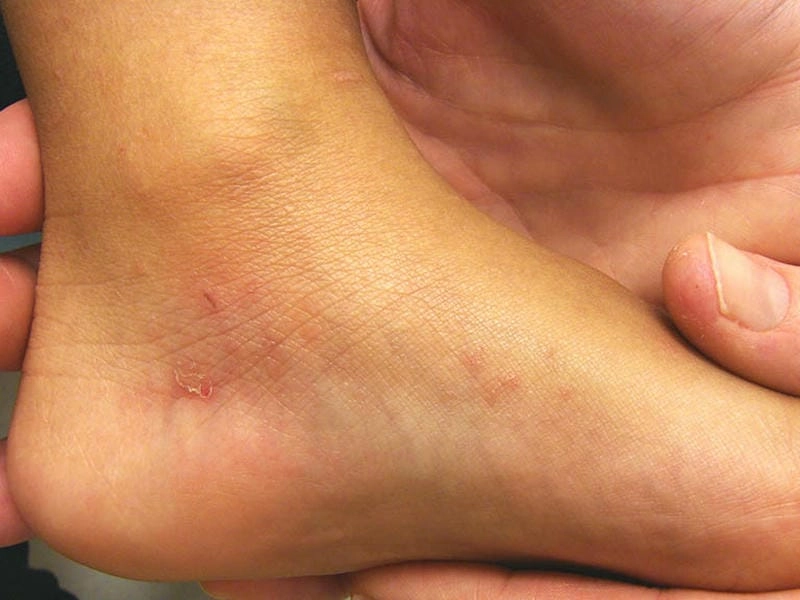 Hình ảnh của bệnh ghẻ nước giúp so sánh mức độ nghiêm trọng