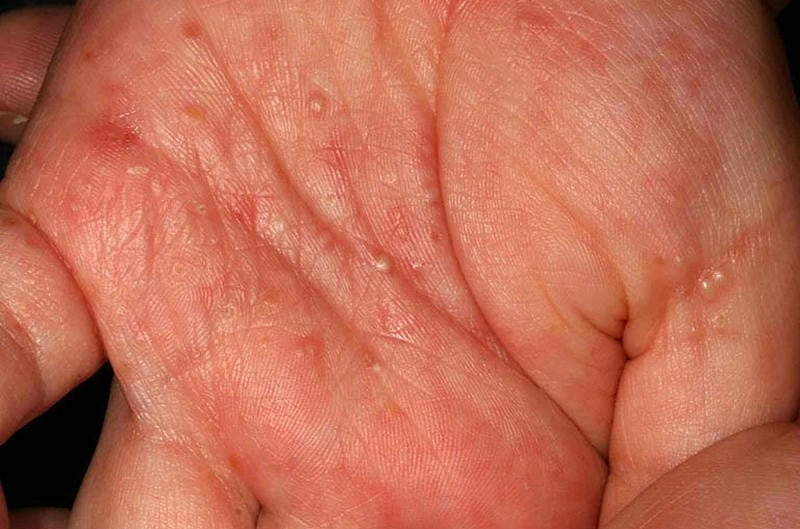 Hình ảnh ghẻ cung cấp dấu hiệu nhận biết trực quan