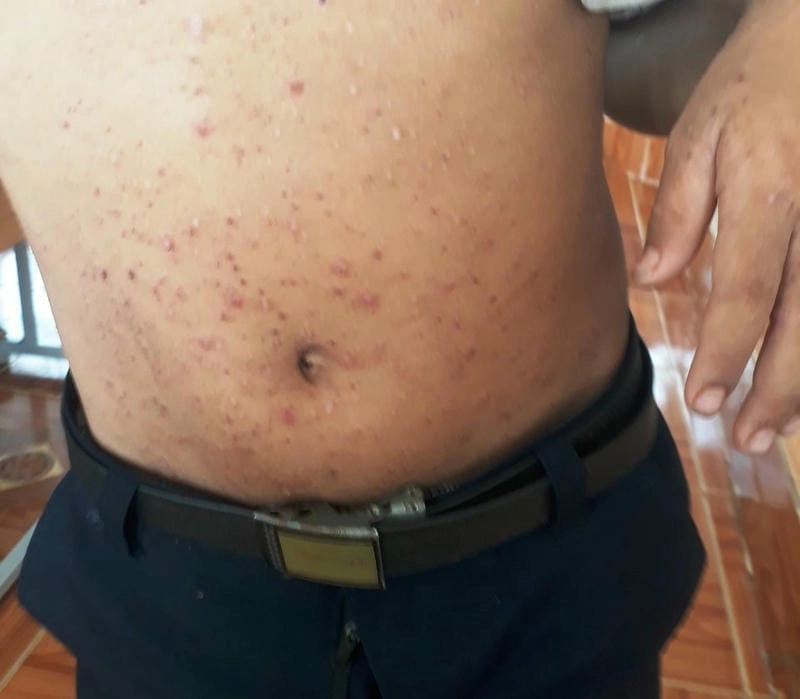 Hình ảnh ghẻ chàm cho thấy tổn thương da kéo dài