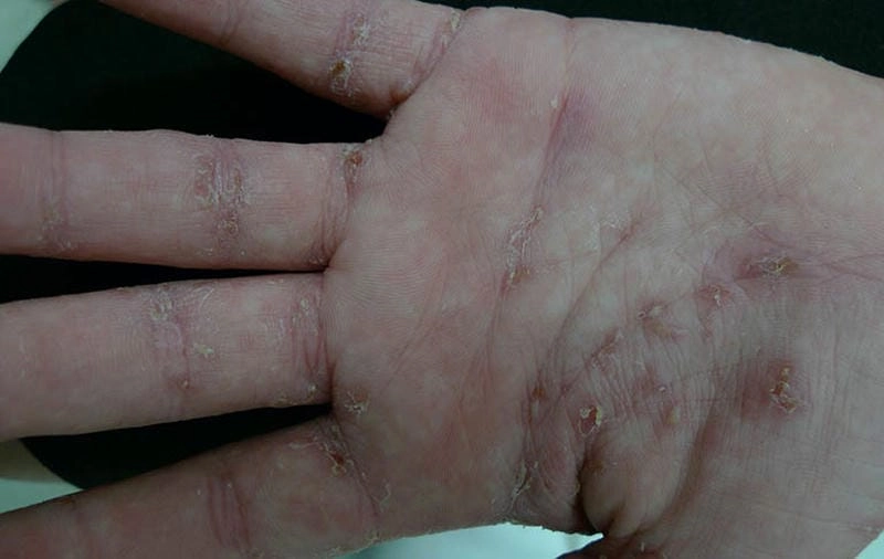 Hình ảnh ghẻ lở mô tả biến chứng do nhiễm trùng