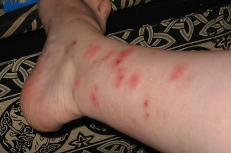 Hình ảnh ghẻ ngứa giúp phân biệt với các bệnh ngoài da khác