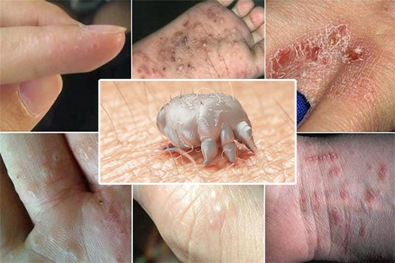 Bệnh ghẻ nước hay gặp ở trẻ nhỏ và người già