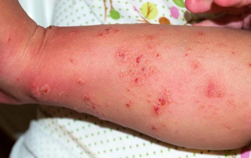 Bệnh ghẻ ngứa gây mất ngủ do ngứa dữ dội