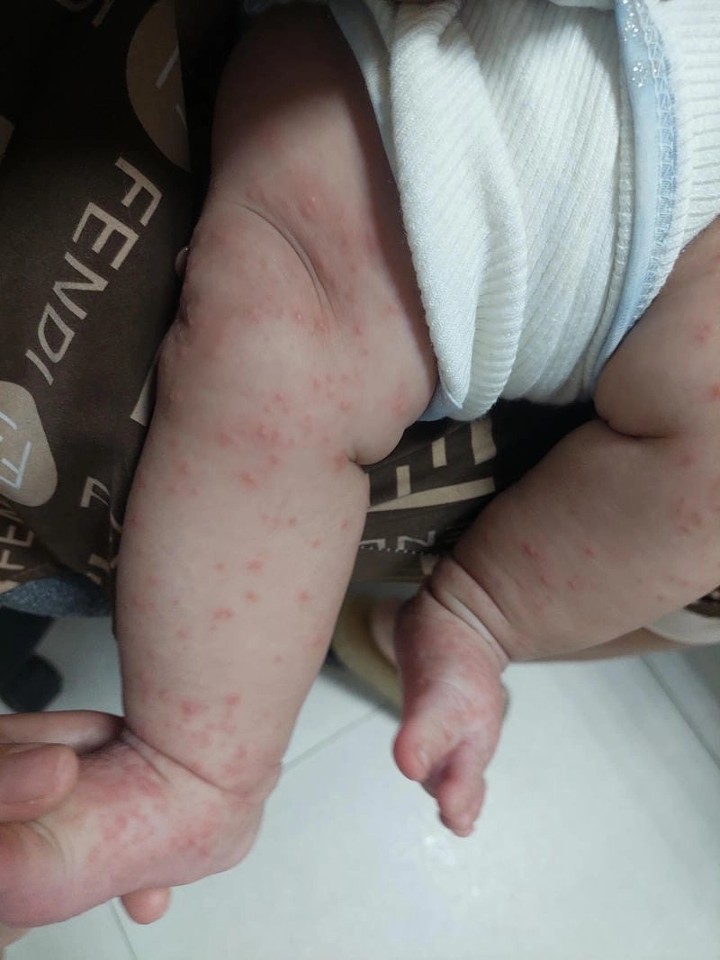 Nhận biết sớm qua hình ảnh bệnh ghẻ ở trẻ em điển hình