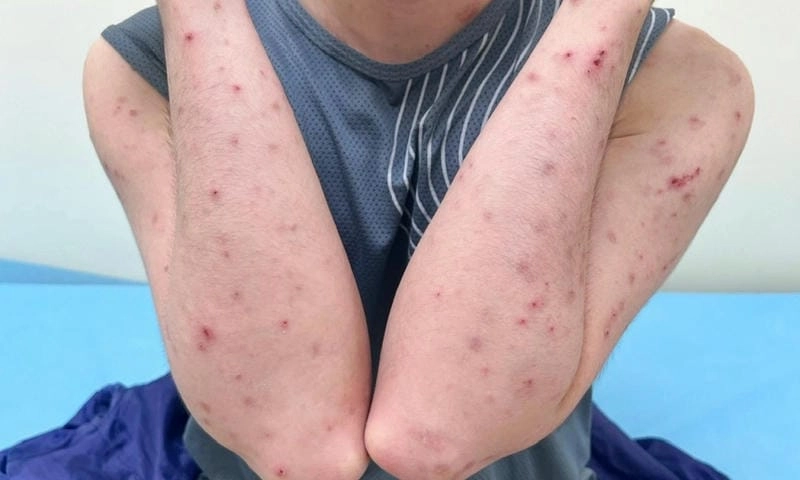 Nhận biết dễ dàng với hình ảnh bệnh ghẻ lở ngoài da