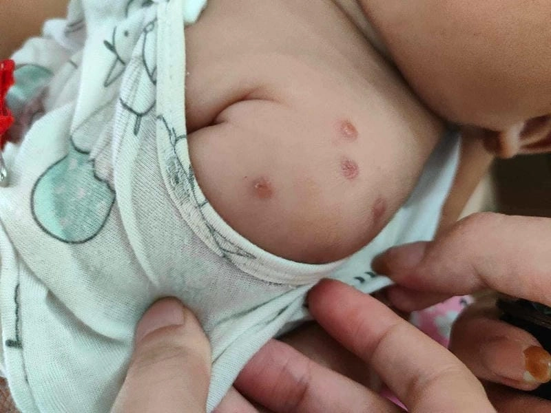 Đừng bỏ qua loạt ảnh bệnh ghẻ nguy hiểm