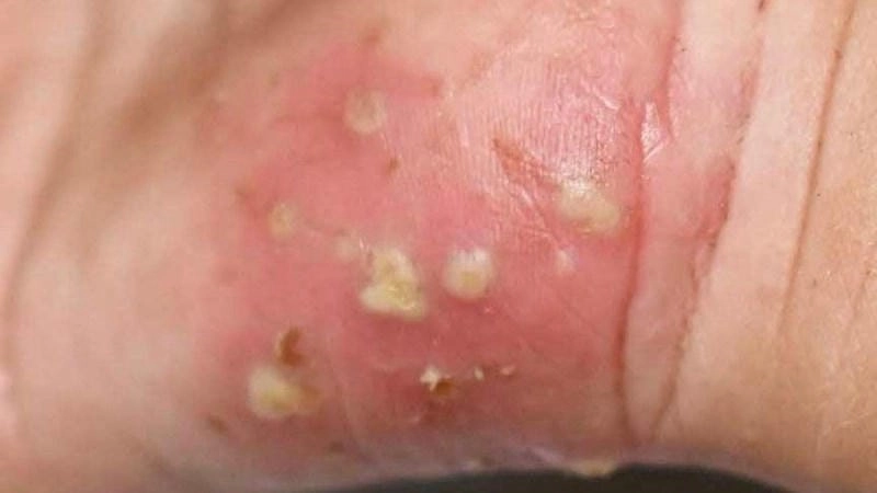 Phân biệt dễ dàng qua hình ảnh ghẻ ngứa thực tế