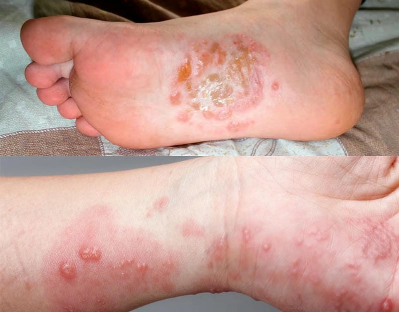 Hình ảnh con ghẻ ngứa thường thấy trên tay và ngón chân