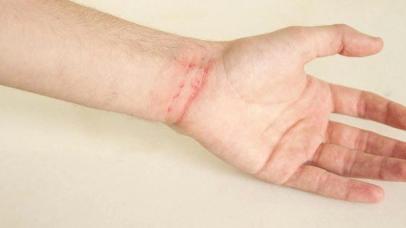 Cập nhật các hình ảnh bệnh ghẻ chuẩn y khoa