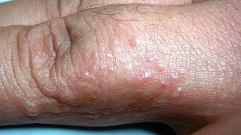 Cảnh báo qua hình ảnh người bị ghẻ thường gặp