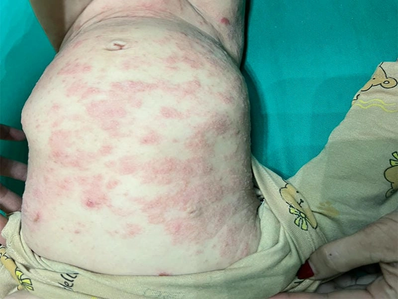 Hình ảnh ghẻ chàm có biểu hiện giống viêm da cơ địa