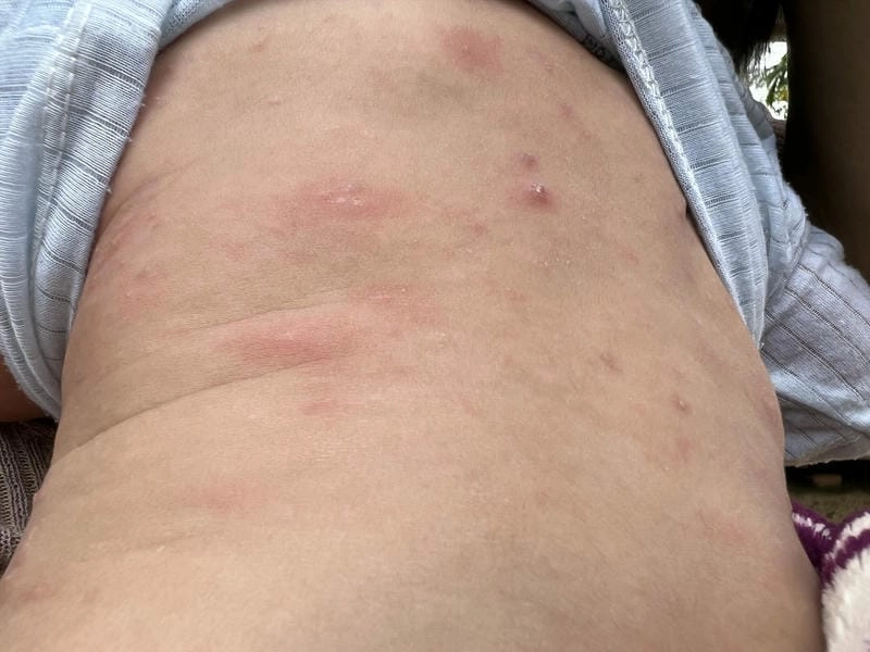 Hình ảnh của bệnh ghẻ nước thường là các mụn nước nhỏ li ti