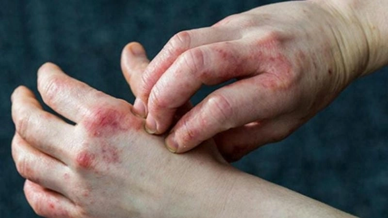 Nhận diện nhanh với hình ảnh ghẻ nước rõ nét