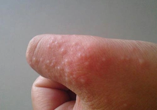 Xem chi tiết tình trạng qua hình ảnh ghẻ nước ở trẻ em