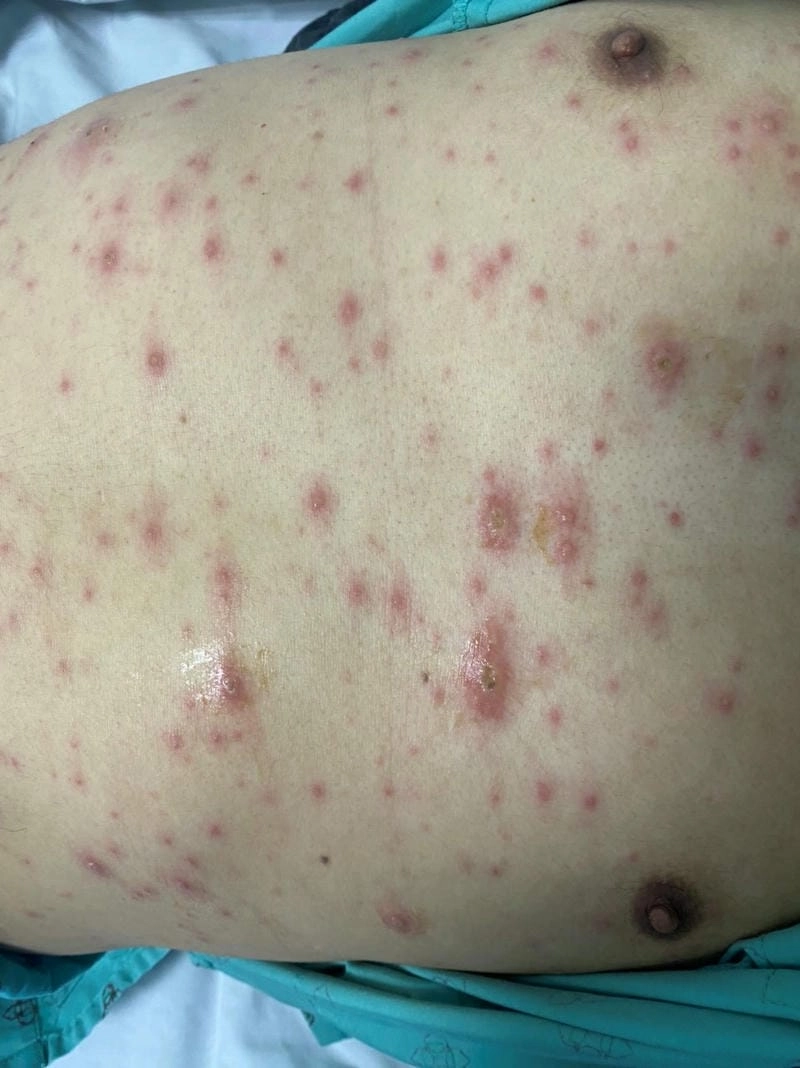 Cập nhật tình trạng qua hình ảnh bị ghẻ nước thật