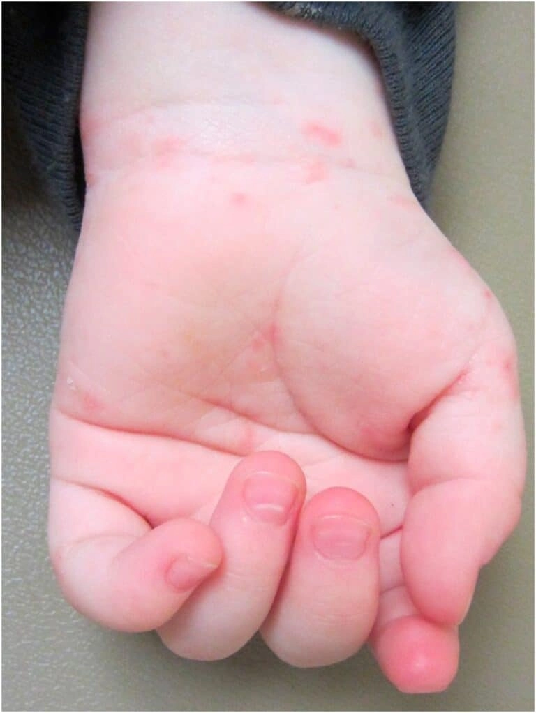 Tham khảo nhanh bộ hình ảnh ghẻ ở trẻ chính xác