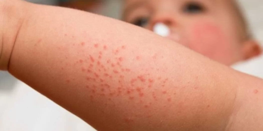 Dễ hiểu tình trạng qua ảnh ghẻ ở trẻ em minh họa