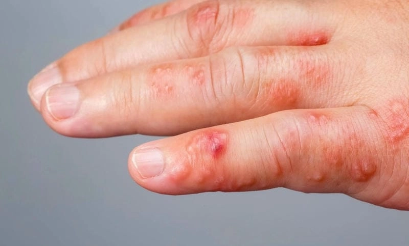 Xử lý kịp thời khi thấy trẻ em bị ghẻ ngứa khó chịu