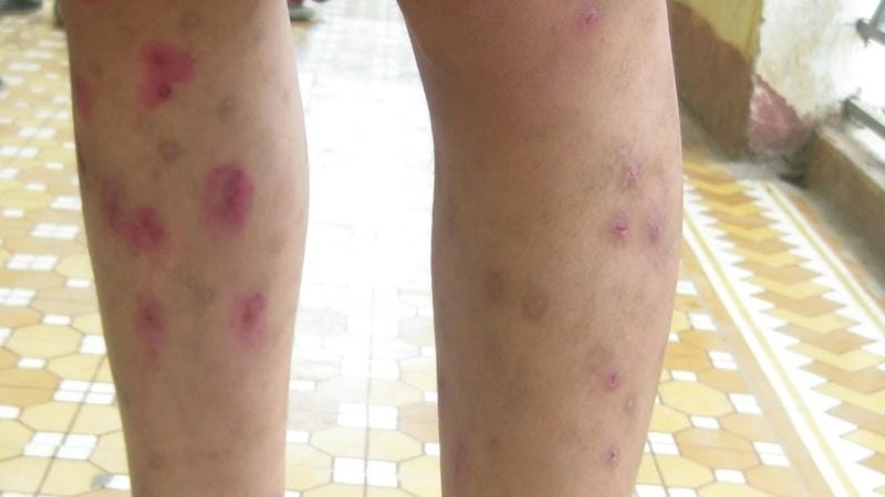 Mẹ cần lưu ý dấu hiệu trẻ bị ghẻ sớm