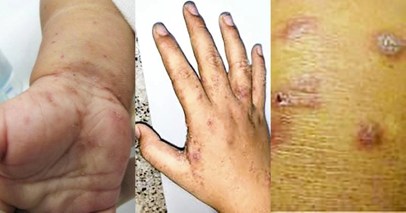 Cách xử lý hiệu quả bệnh cái ghẻ ở trẻ em