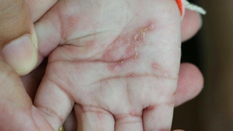 Biểu hiện và hình ảnh bệnh ghẻ ở trẻ em dễ hiểu