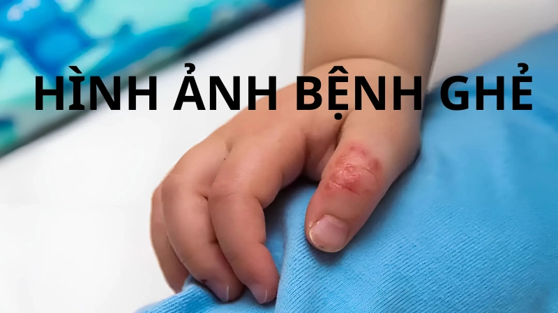 Hình ảnh bệnh ghẻ ở trẻ em là như thế nào gây sốc