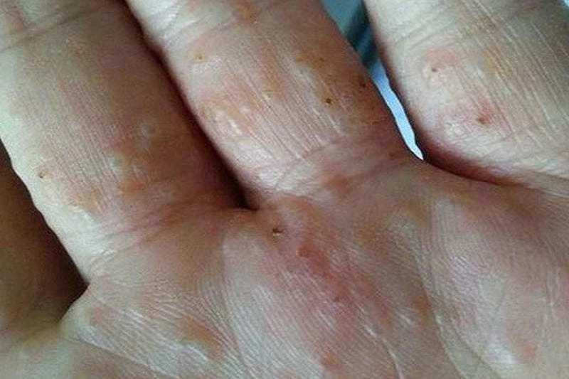 Tổng hợp thực tế hình ảnh người bệnh ghẻ ruồi