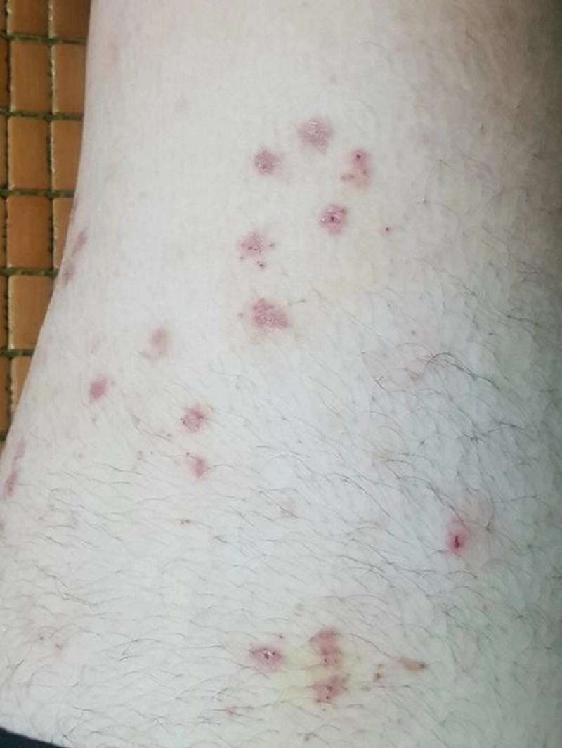 Khám phá thực tế ảnh người bị bệnh ghẻ ruồi dễ hiểu