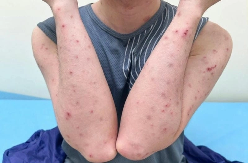 Hình ảnh thật về ghẻ ngứa ghẻ ruồi trên da người