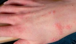 Xem rõ dấu hiệu qua triệu chứng ghẻ ruồi ngoài da