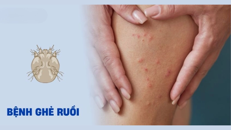 Hình ảnh bệnh ghẻ ruồi là như thế nào