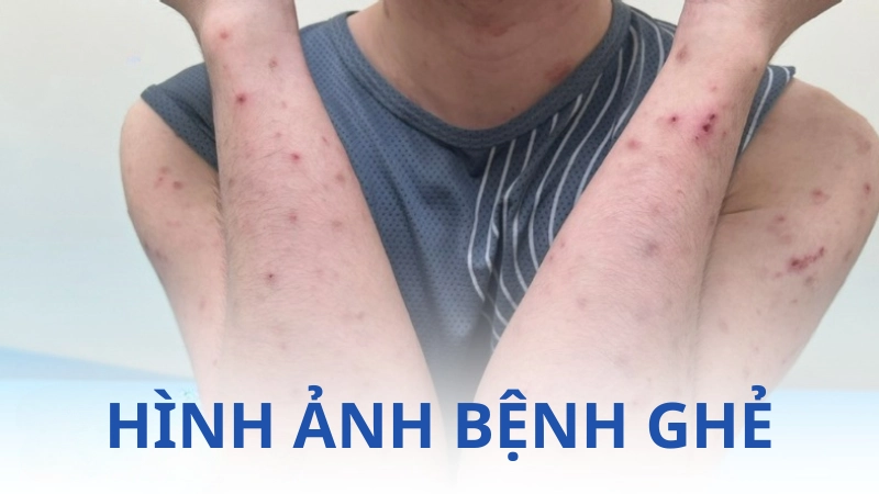 Hình ảnh bệnh ghẻ là như thế nào mà khiến rùng mình