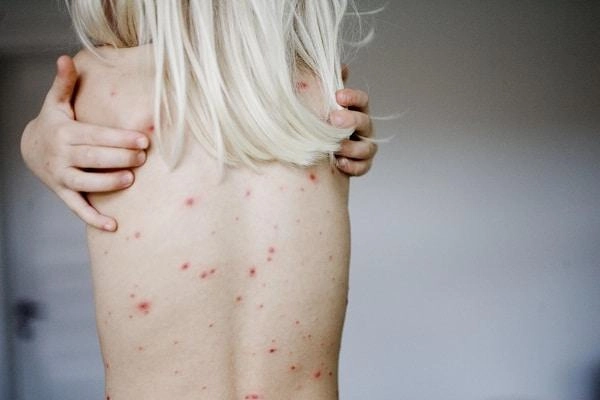 Hình ảnh bệnh giang mai giai đoạn 1 thể hiện rõ vết trợt nông không ngứa