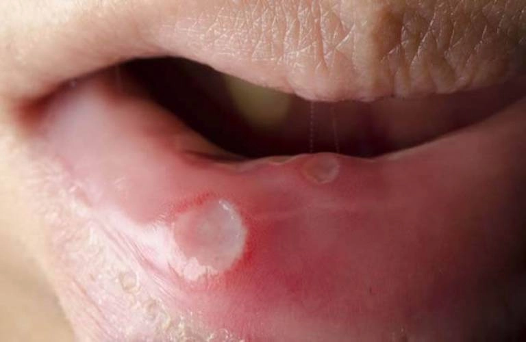 Hình ảnh bệnh giang mai giai đoạn 1 cho thấy vết loét không gây đau