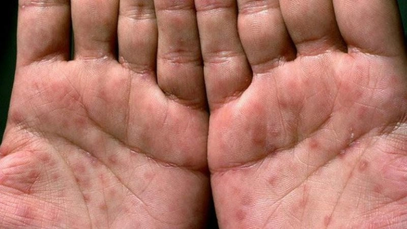 Nhận diện hình ảnh bệnh giang mai ở nam giới