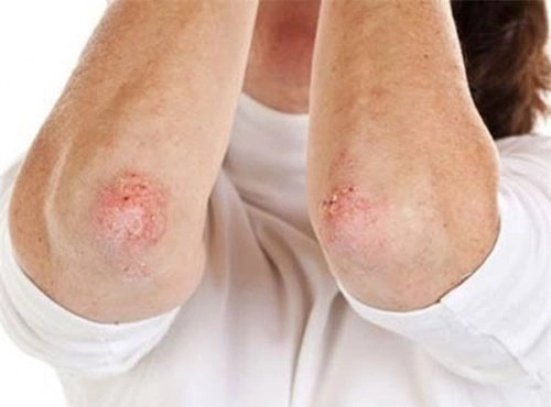 Hình ảnh bênh giang mai thường gặp ở miệng tay chân và bộ phận kín