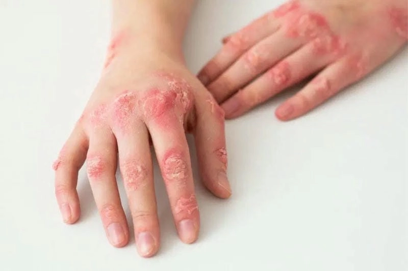 Đừng bỏ qua hình ảnh về bệnh giang mai