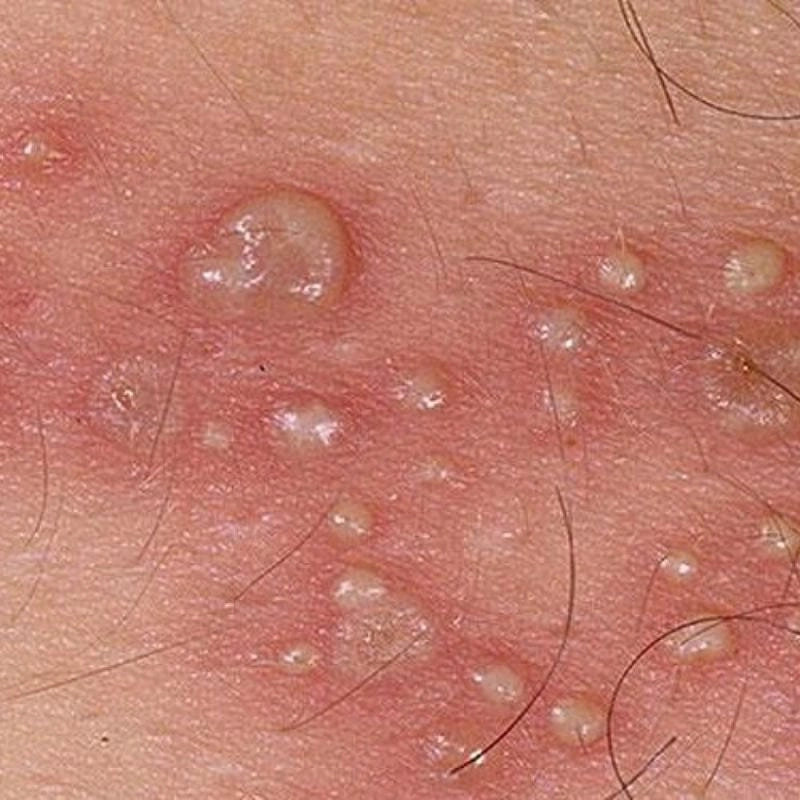 Đầy đủ hình ảnh bệnh hình ảnh bệnh giang mai