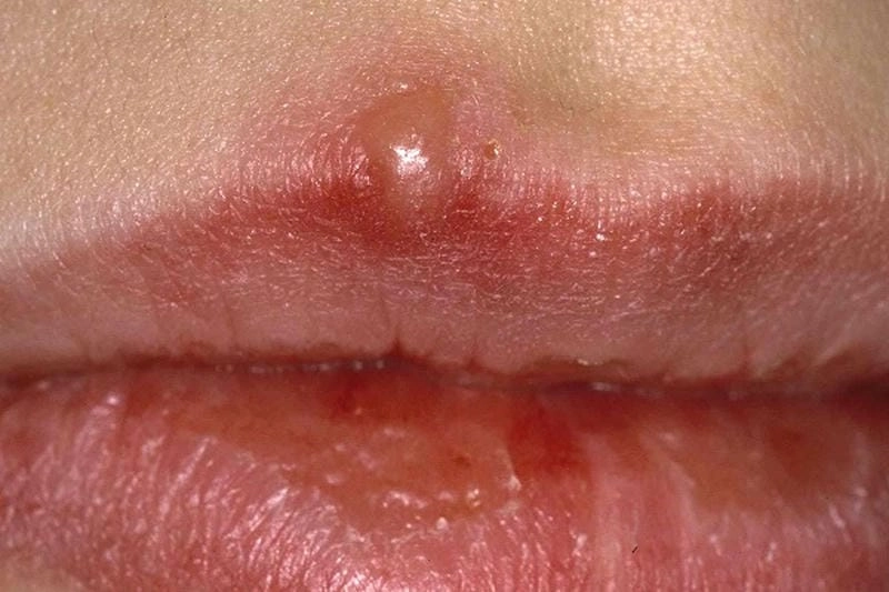 Cập nhật hình ảnh dấu hiệu bệnh giang mai ở nữ giới