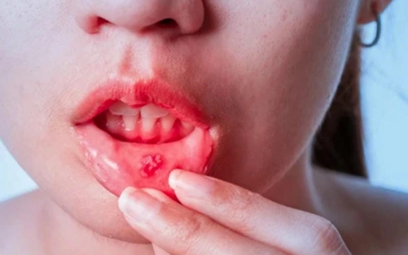 Ảnh con giời leo chân khớp nhiều lông nhỏ