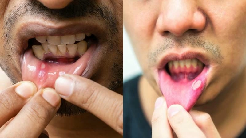 Dấu hiệu bị giời leo ở miệng xuất hiện mụn nước rát