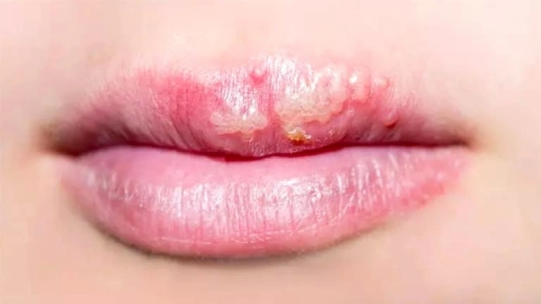 Hình ảnh giời leo quanh miệng thường lan thành từng vệt dài