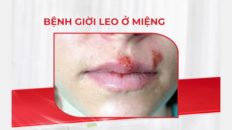 Hình ảnh bệnh giời leo ở môi là như thế nào