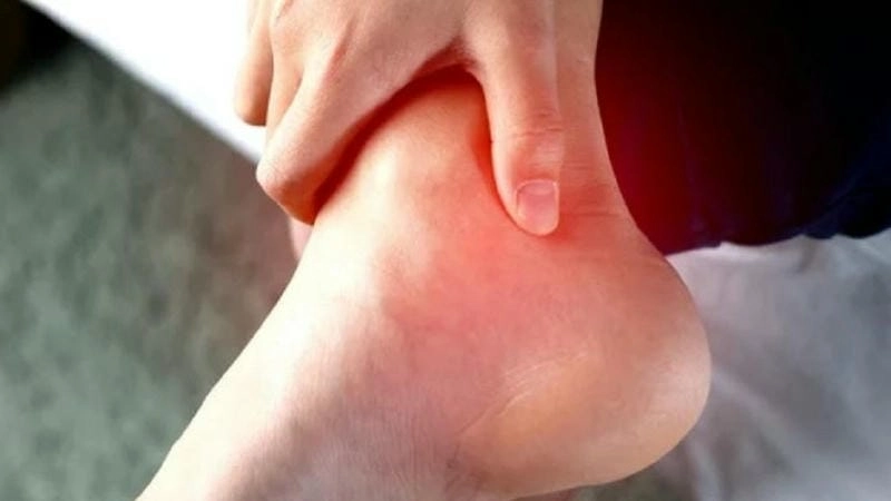 Hình ảnh chân bị gout phản ánh biến dạng và đau nhức