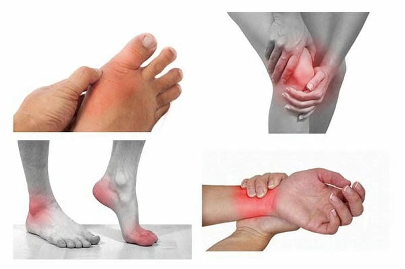 Ảnh gút giúp nhận diện dấu hiệu đặc trưng ban đầu