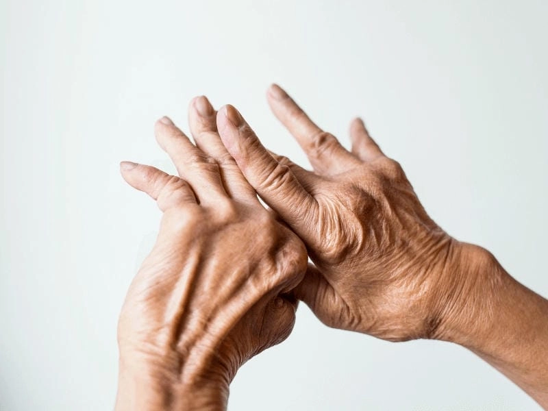 Hình ảnh về bệnh gout giúp người xem hiểu rõ tiến triển