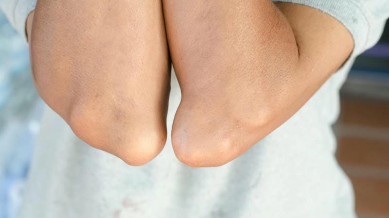 Hình ảnh bệnh gout thể hiện rõ biến chứng thường gặp