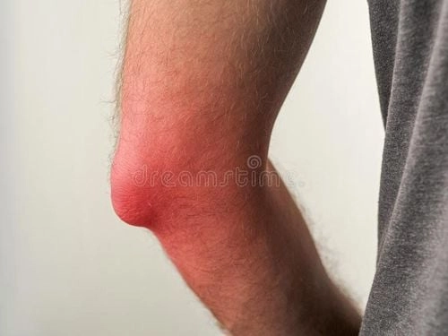 Tìm hiểu triệu chứng qua hình ảnh bệnh gout