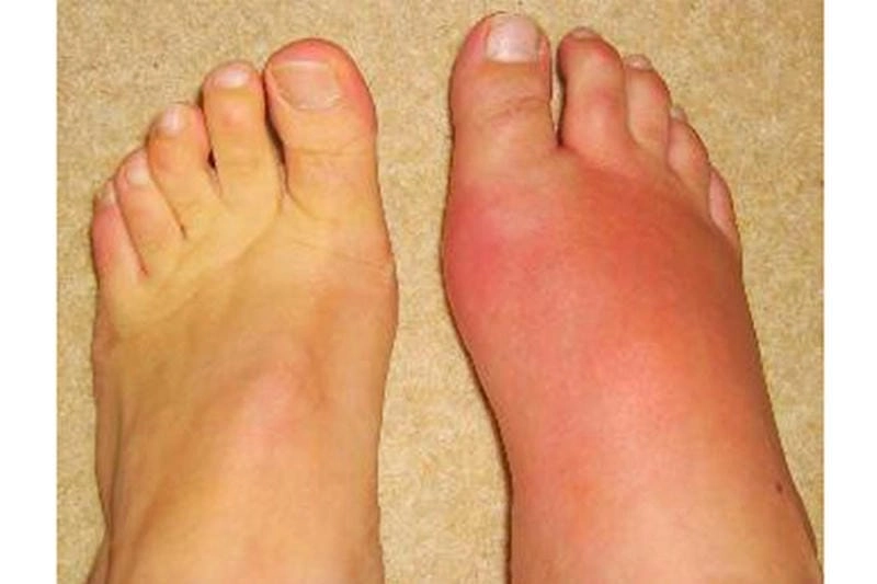 Hình ảnh của bệnh gout thể hiện các khối tophi đặc trưng